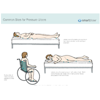 Common Sites for Pressure Ulcers
