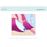 Ear Tube