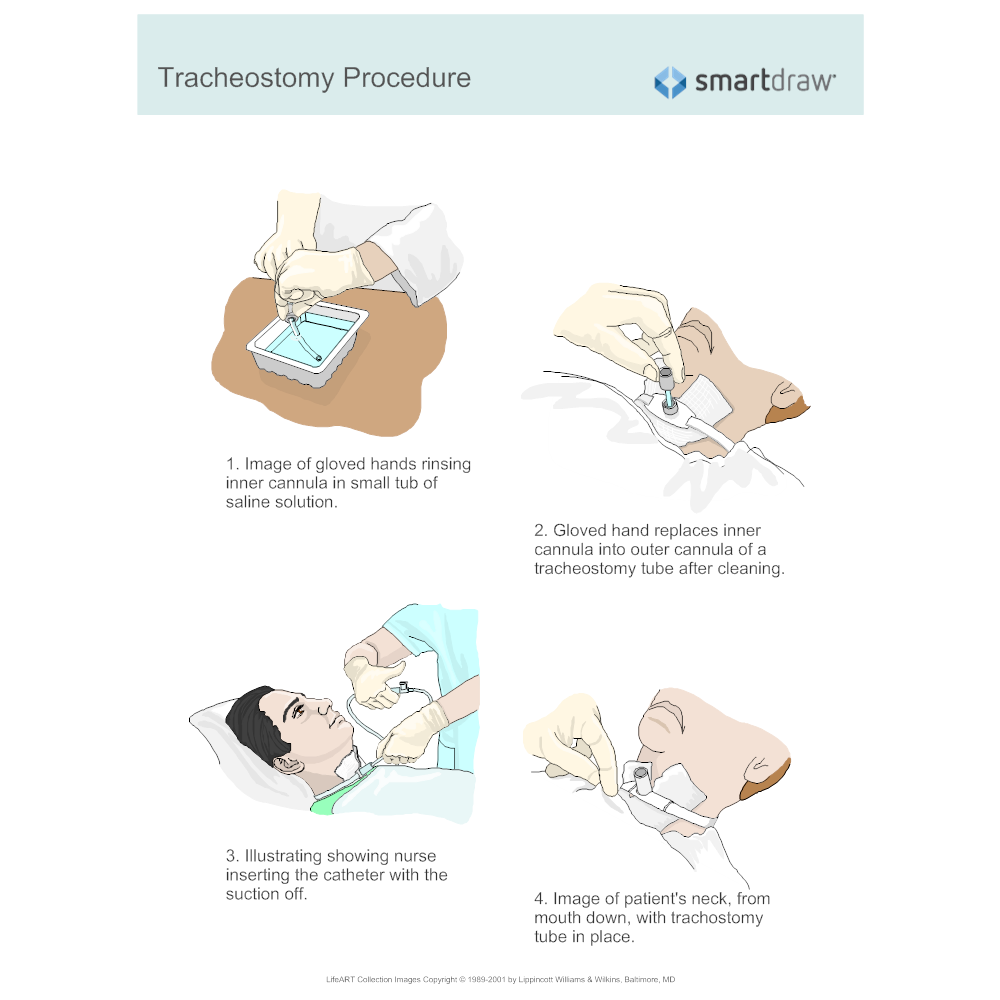 Example Image: Tracheostomy