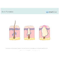 Acne Formation