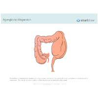 Aganglionic Megacolon
