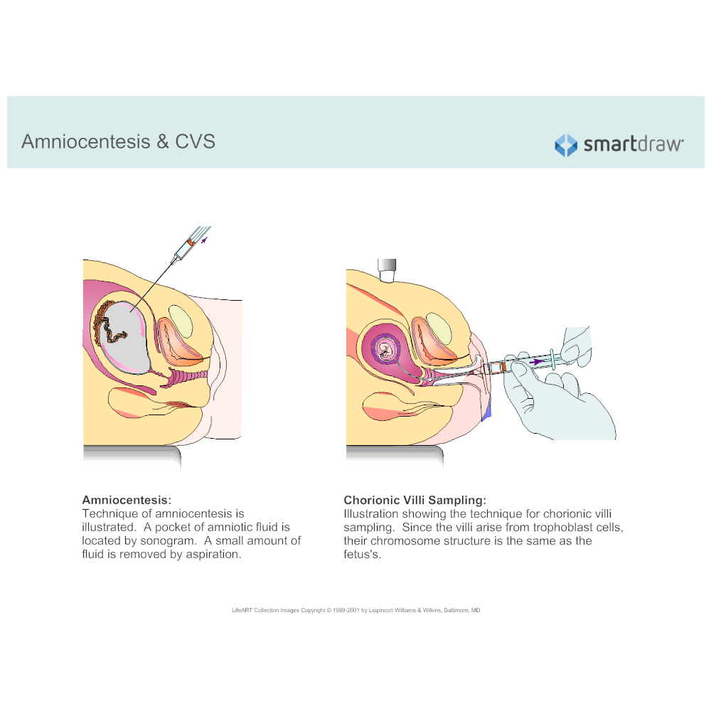Example Image: Amniocentesis & CVS