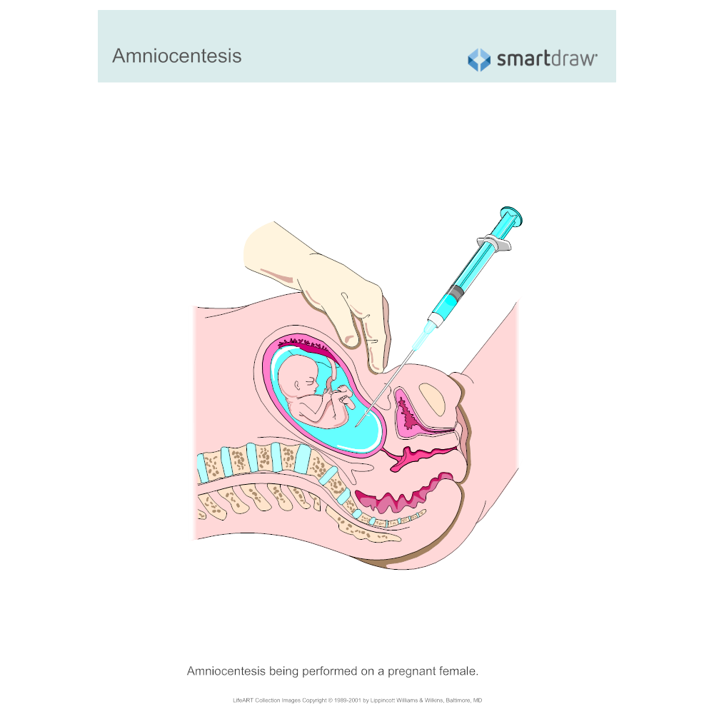 Example Image: Amniocentesis