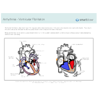 Arrhythmia - Ventricular Fibrillation