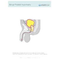 Benign Prostatic Hypertrophy