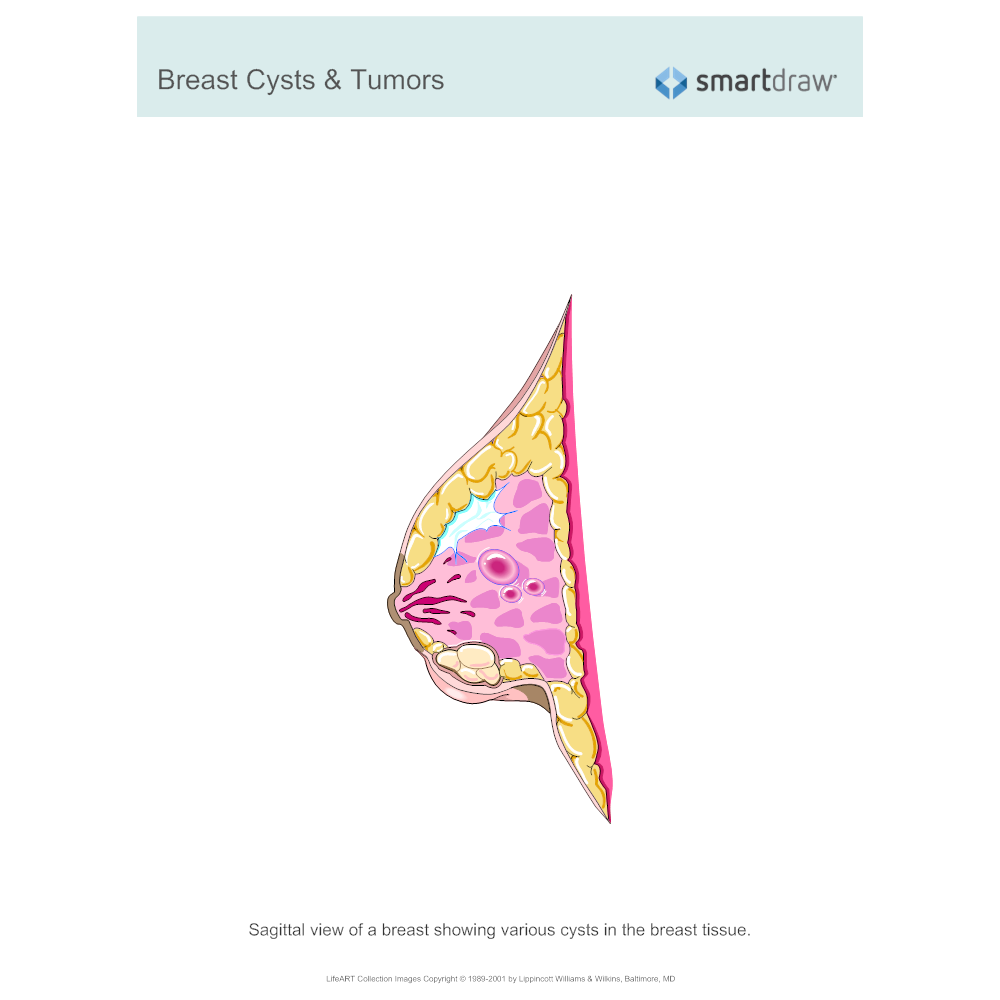 Example Image: Breast Cysts & Tumors
