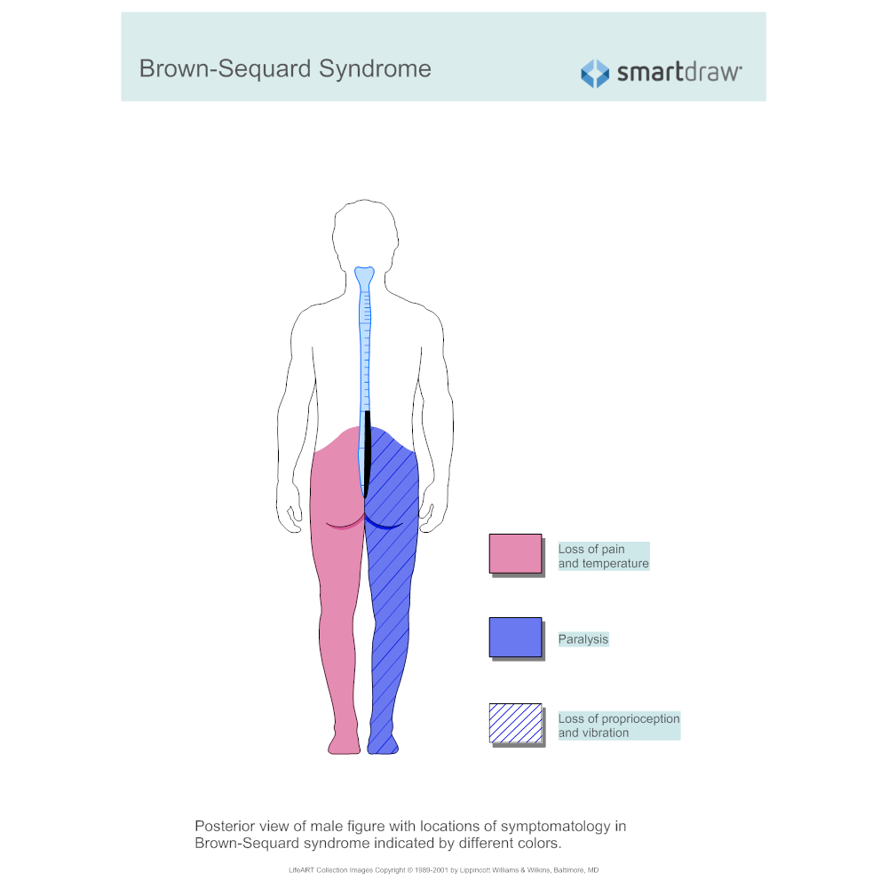Example Image: Brown-Sequard Syndrome