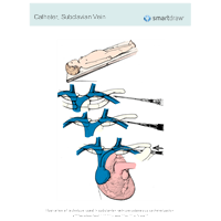 Catheter - Subclavian Vein