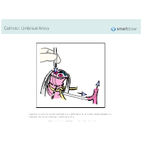 Catheter - Umbilical Artery