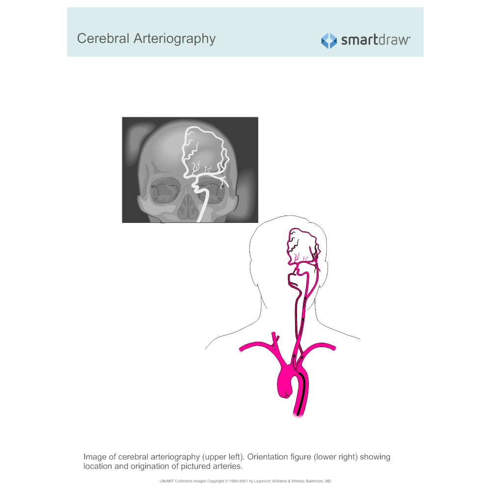 Example Image: Cerebral Arteriography
