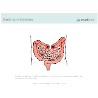 Colostomy - Double-barrel