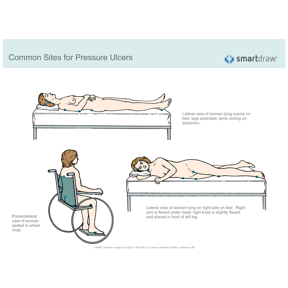 Example Image: Common Sites for Pressure Ulcers