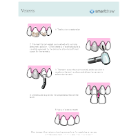 Dental Veneers Process