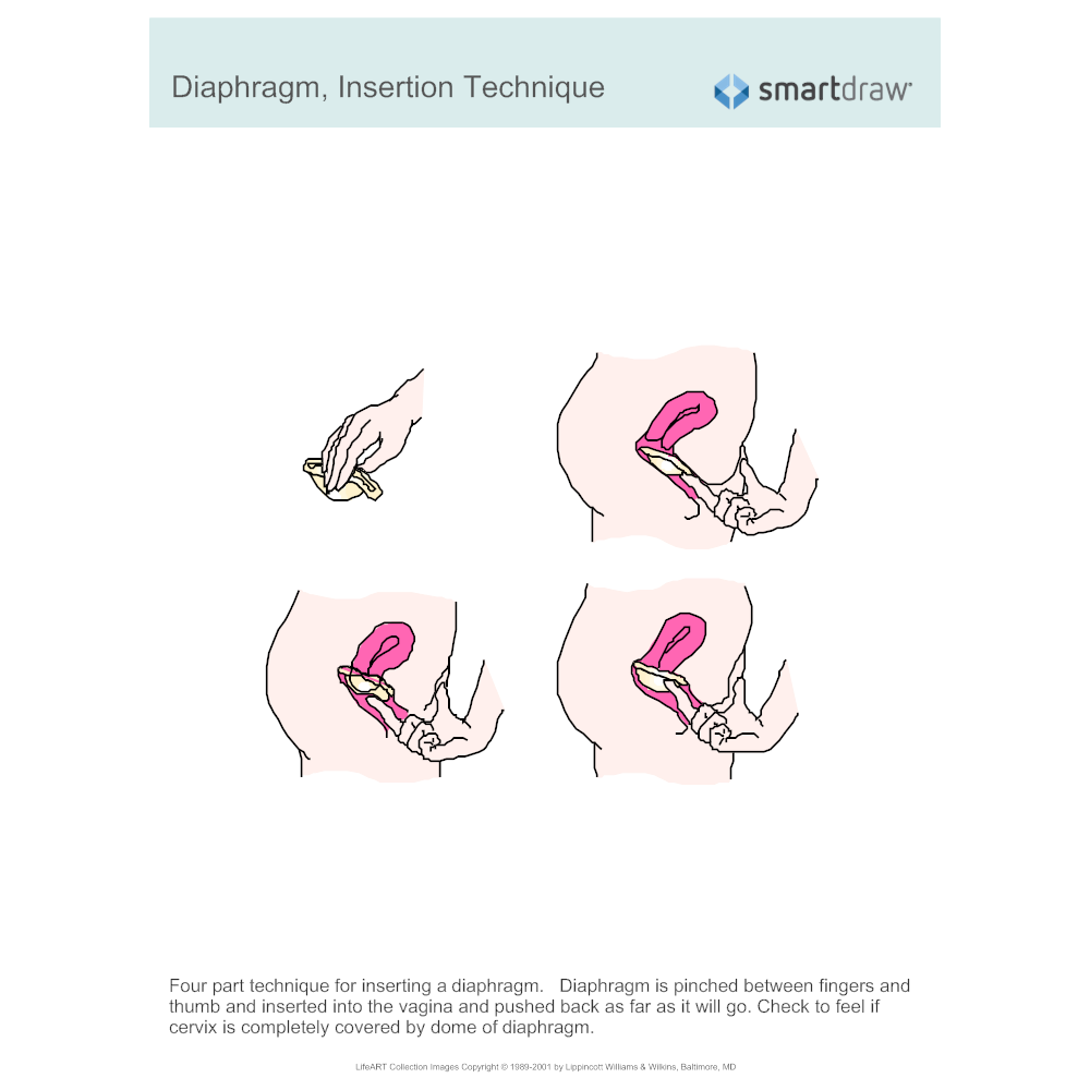 Example Image: Diaphragm, Insertion Technique