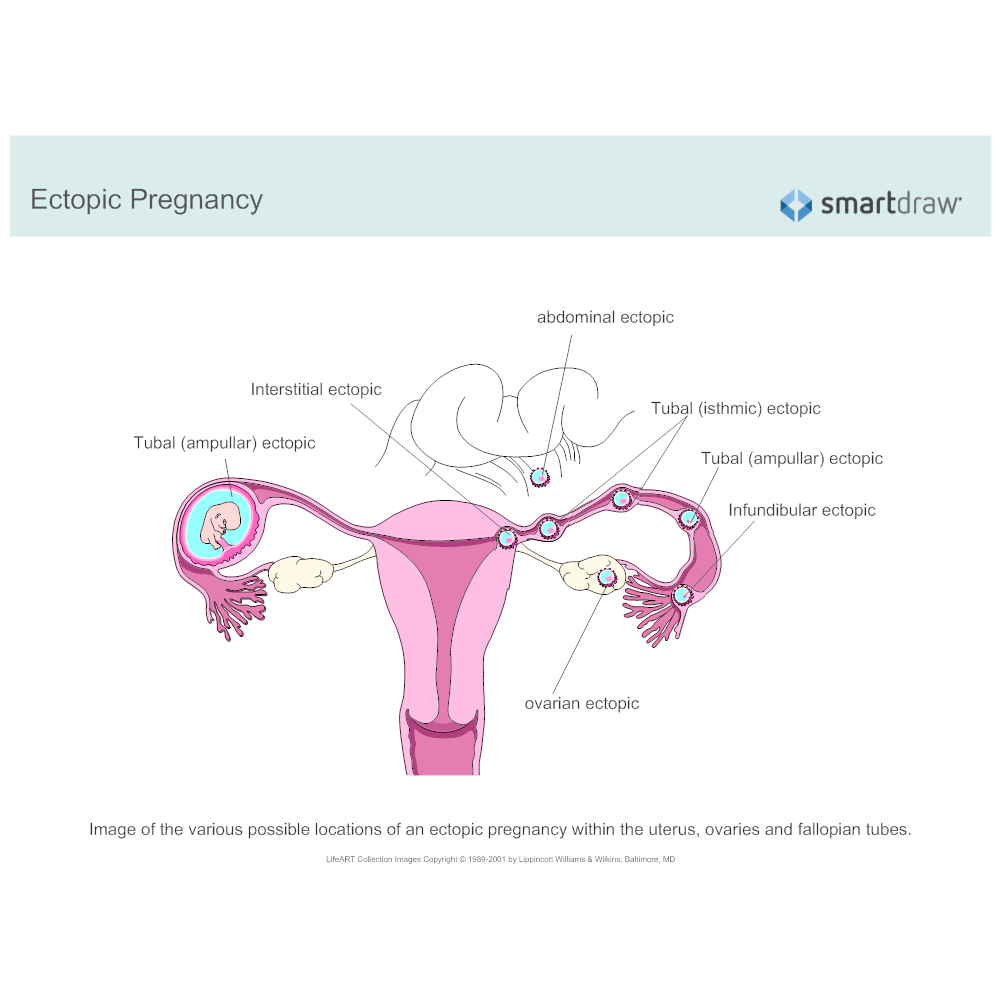 Example Image: Ectopic Pregnancy