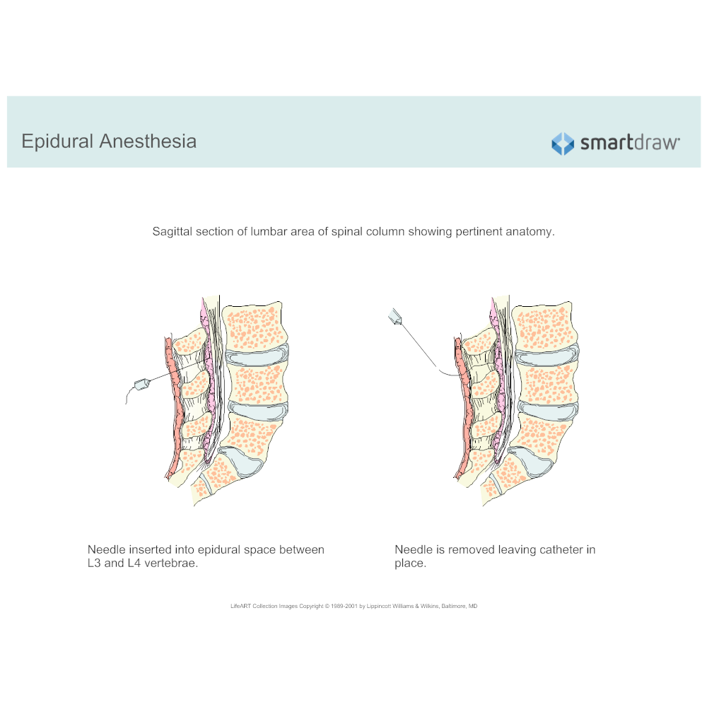Example Image: Epidural Anesthesia