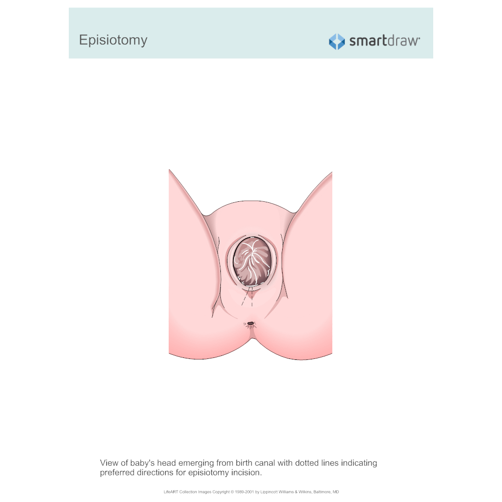 Example Image: Episiotomy
