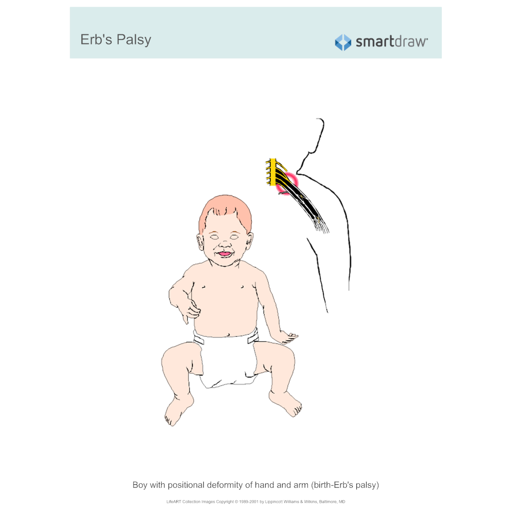 Example Image: Erb's Palsy