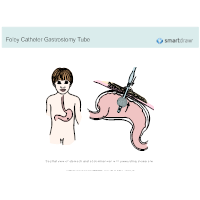 Foley Catheter Gastrostomy Tube