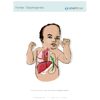 Hernia - Diaphragmatic
