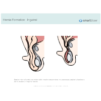 Hernia Formation - Inguinal