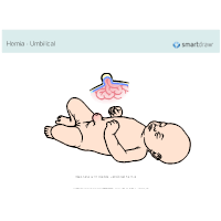 Hernia - Umbilical