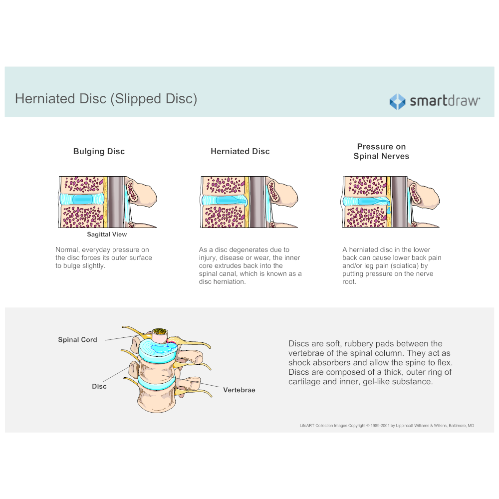 Example Image: Herniated Disc