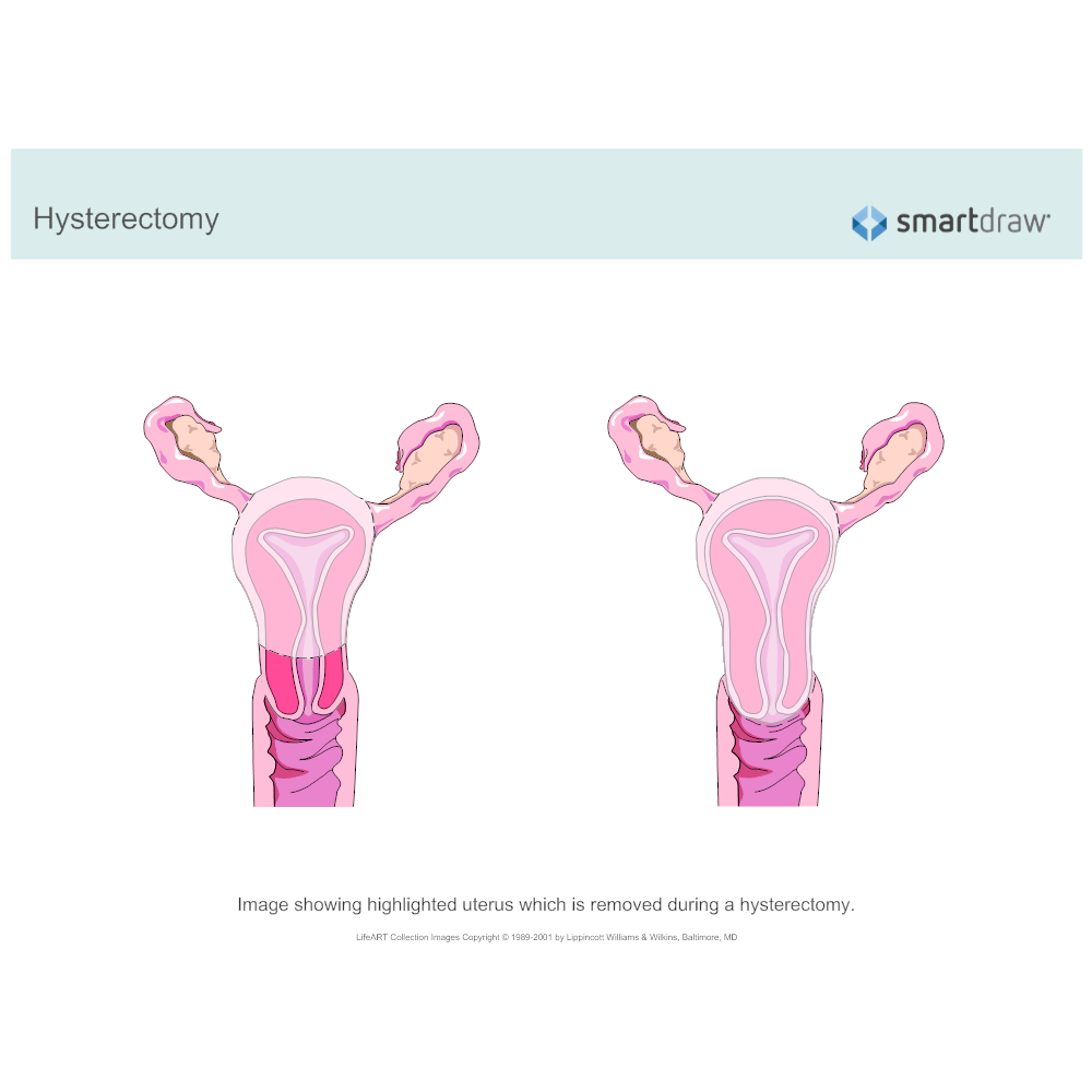Example Image: Hysterectomy