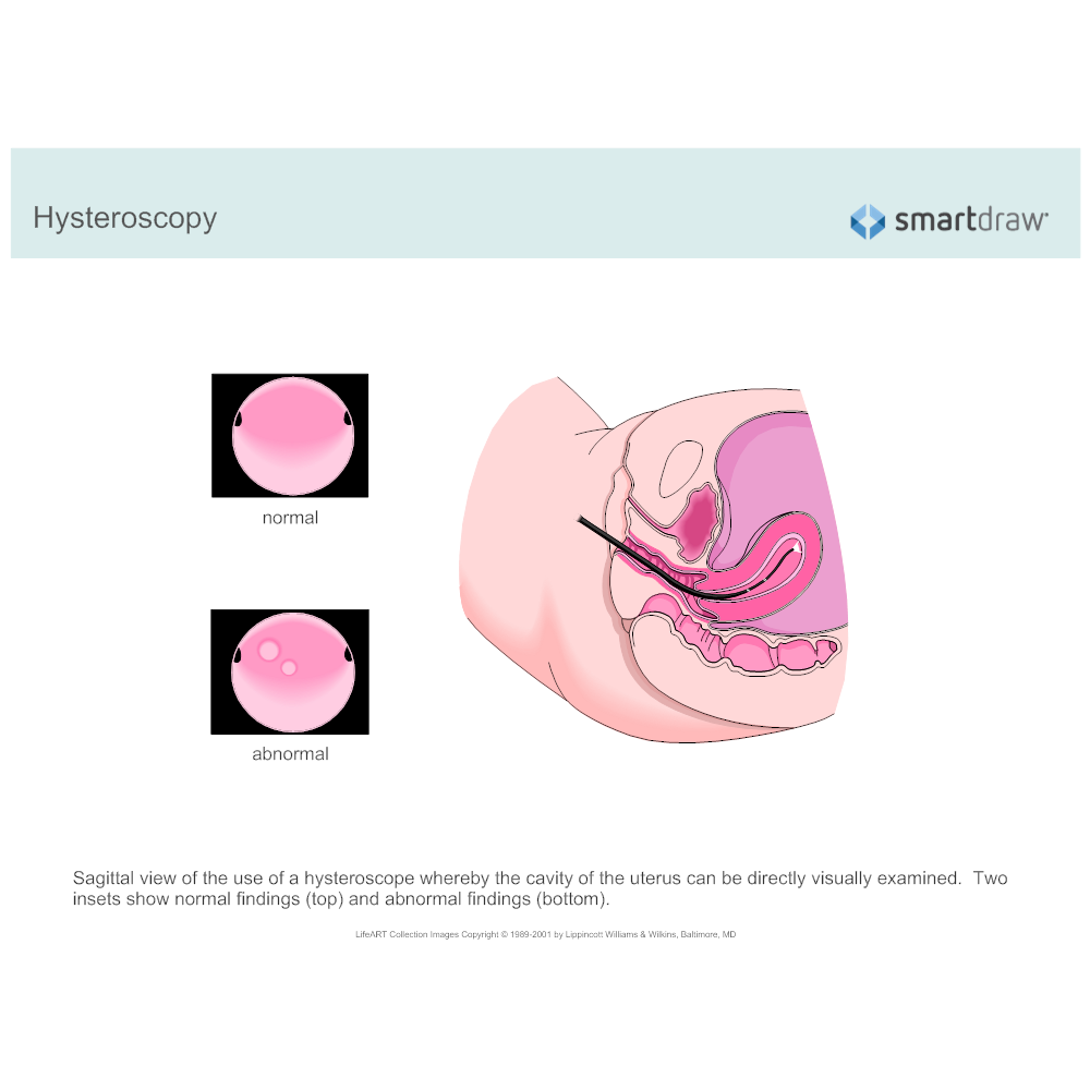 Example Image: Hysteroscopy