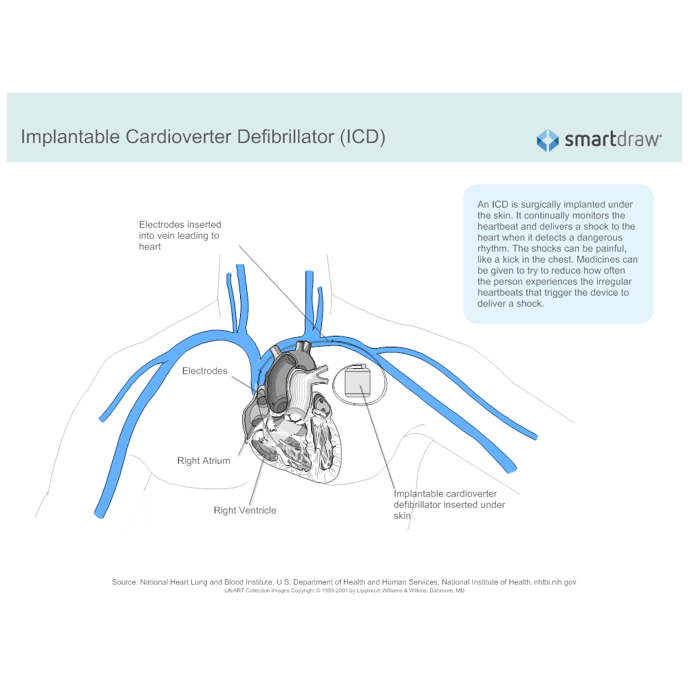 Example Image: Implantable Cardioverter Defibrillator