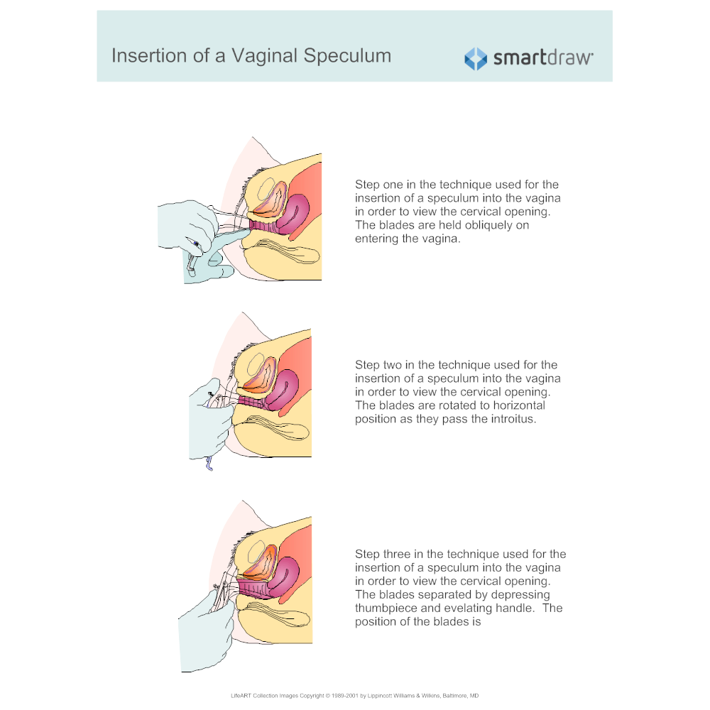 Example Image: Insertion of a Vaginal Speculum