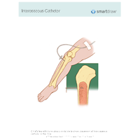 Interosseous Catheter