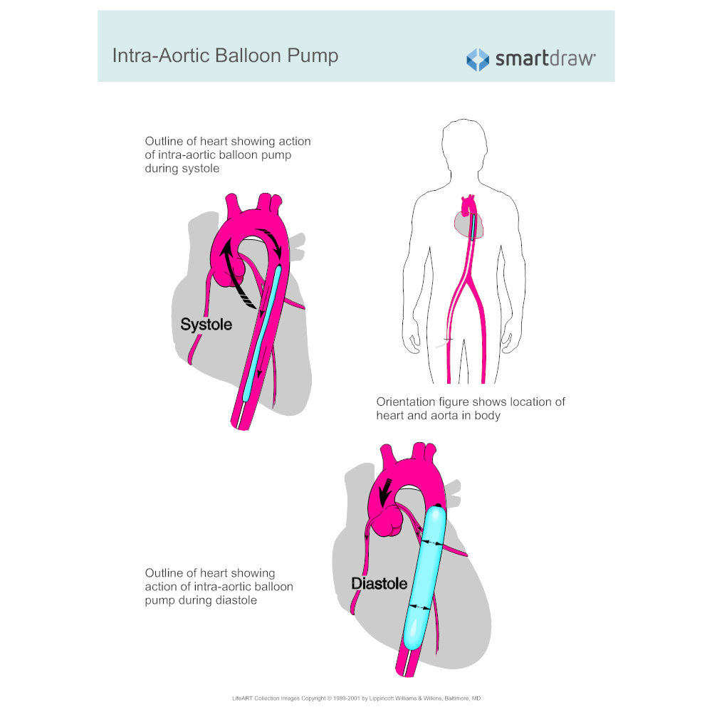 Example Image: Intra-Aortic Balloon Pump
