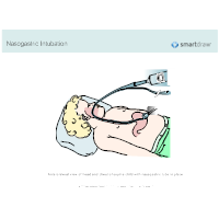 Nasogastric Intubation - 2