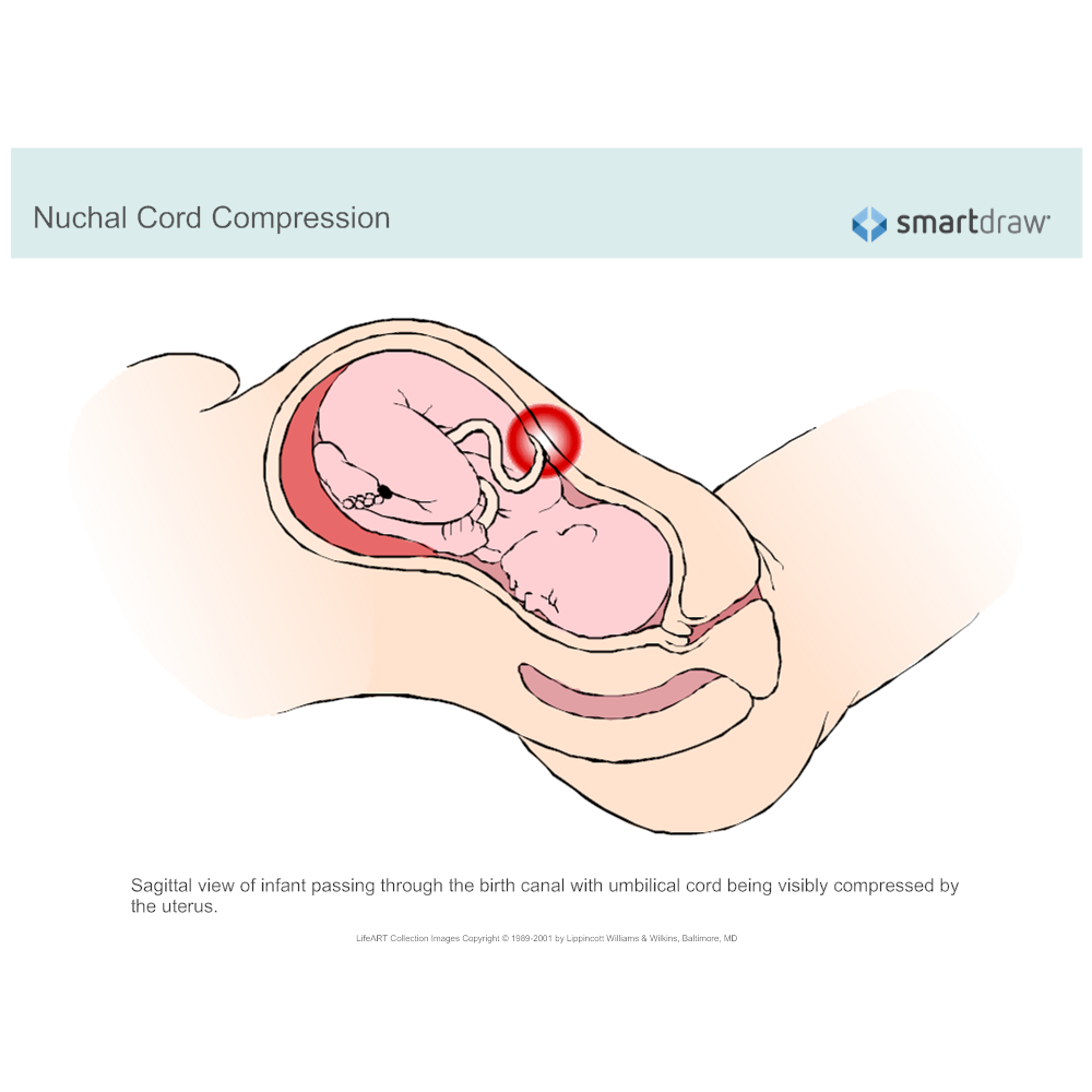 Example Image: Nuchal Cord Compression