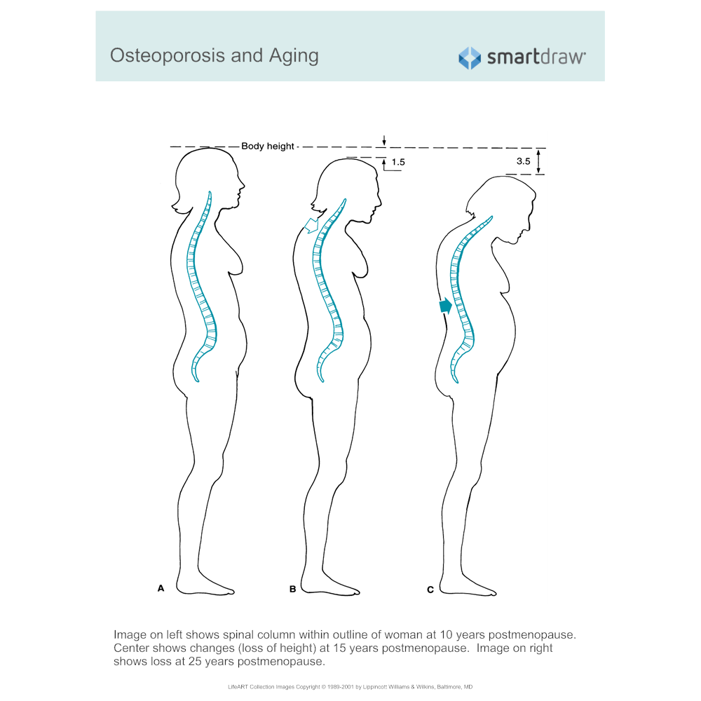 Example Image: Osteoporosis and Aging