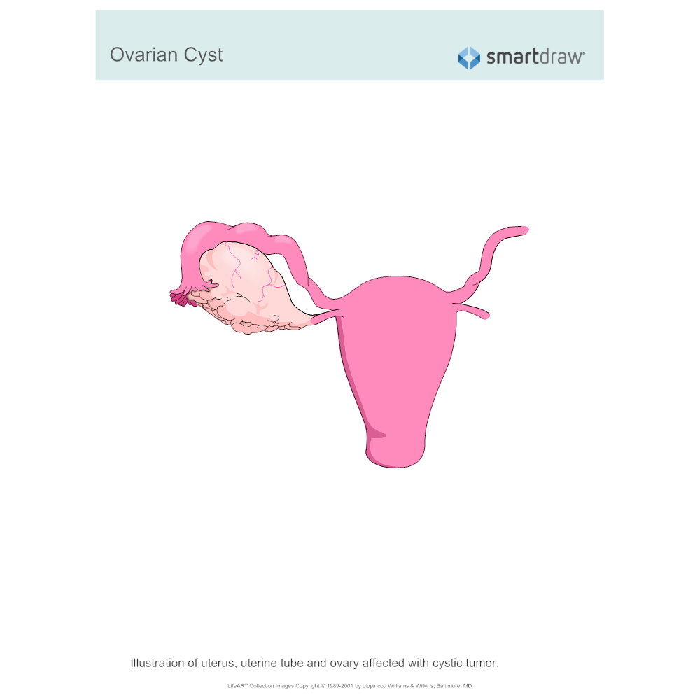 Example Image: Ovarian Cyst