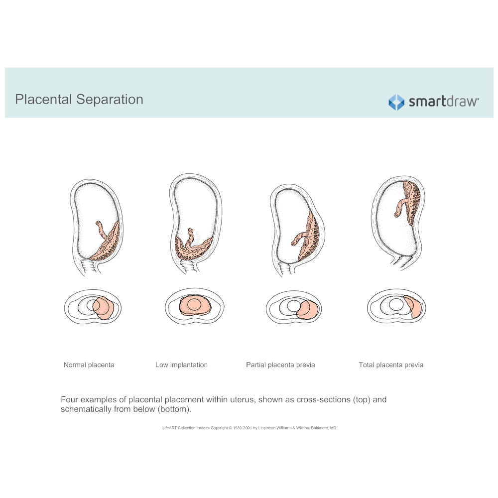 Example Image: Partial Placenta Previa