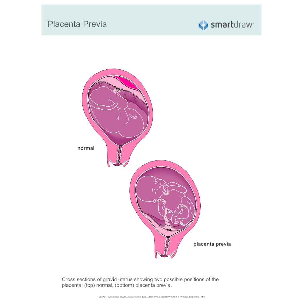 Example Image: Placenta Previa