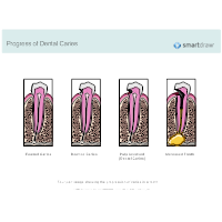 Progress of Dental Caries
