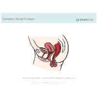 Rectal Prolapse - Complete