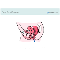 Rectal Prolapse - Partial