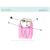 Sites for Caries