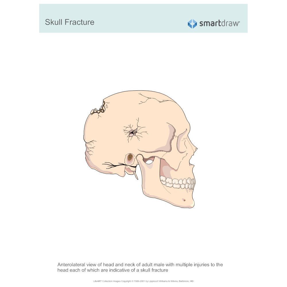 Example Image: Skull Fracture