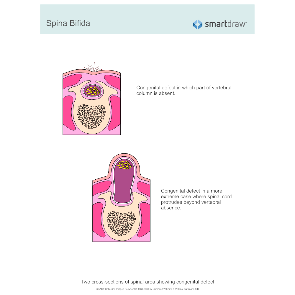 Example Image: Spina Bifida