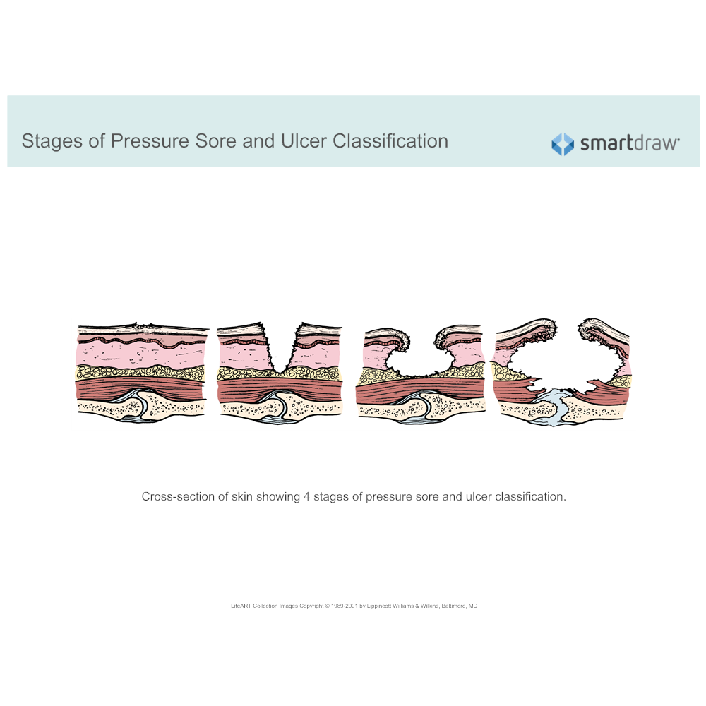 Example Image: Stages of Pressure Sore and Ulcer Classification