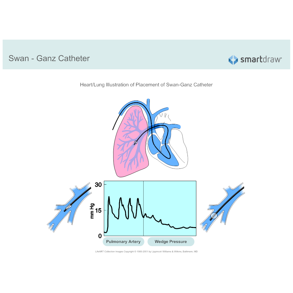 Example Image: Swan-Ganz Catheter