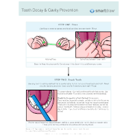 Tooth Decay (Caries) and Cavity Prevention