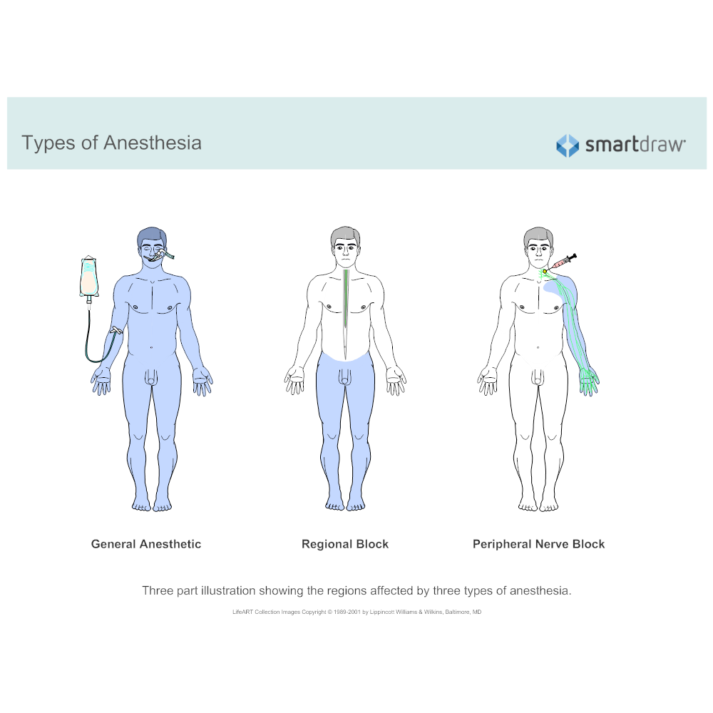Example Image: Types of Anesthesia