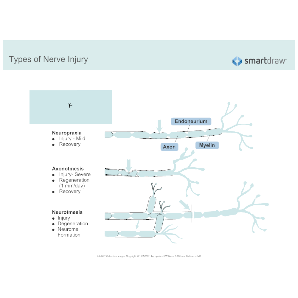 Example Image: Types of Nerve Injury